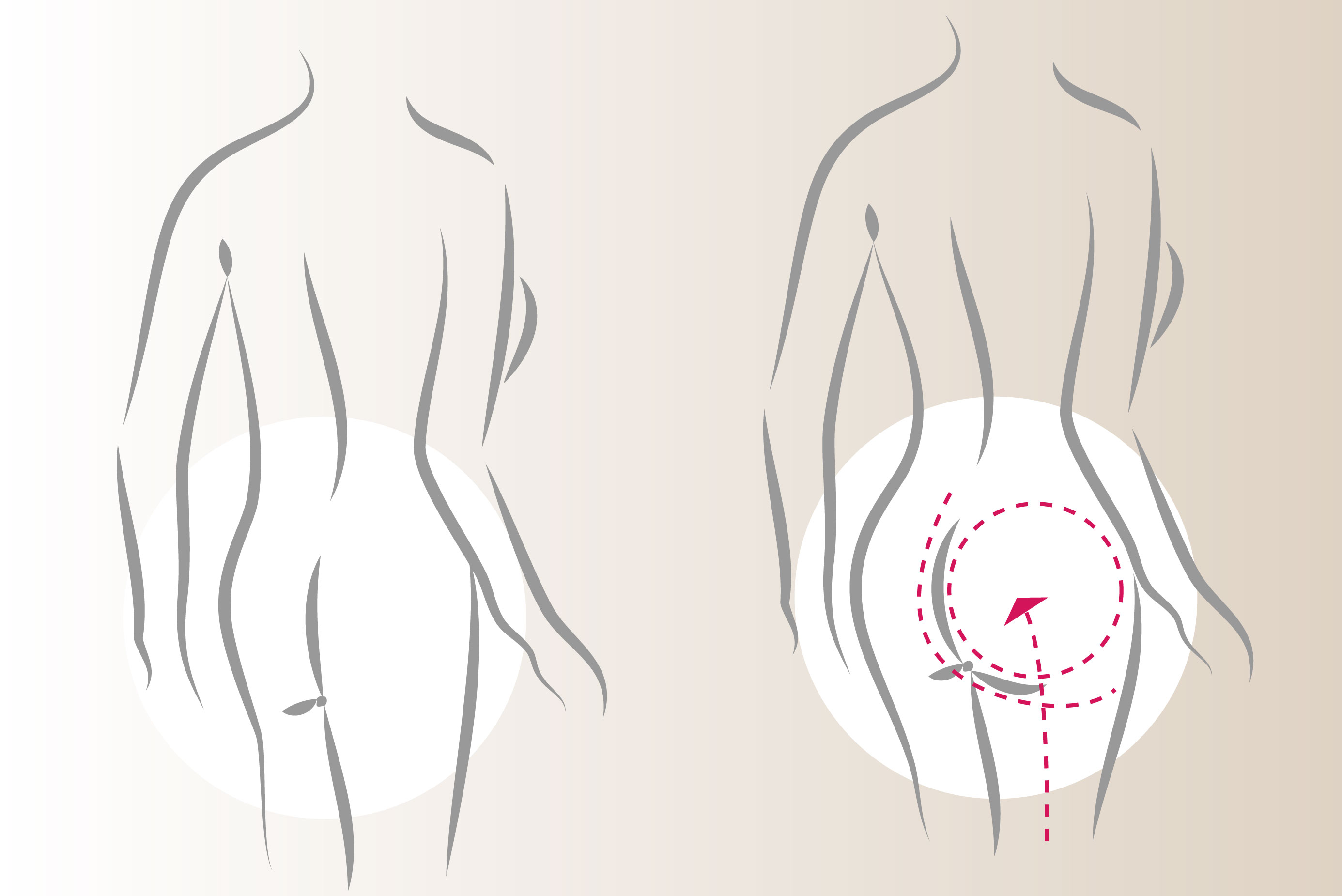 Gluteoplastia - Aumento de Glteos
