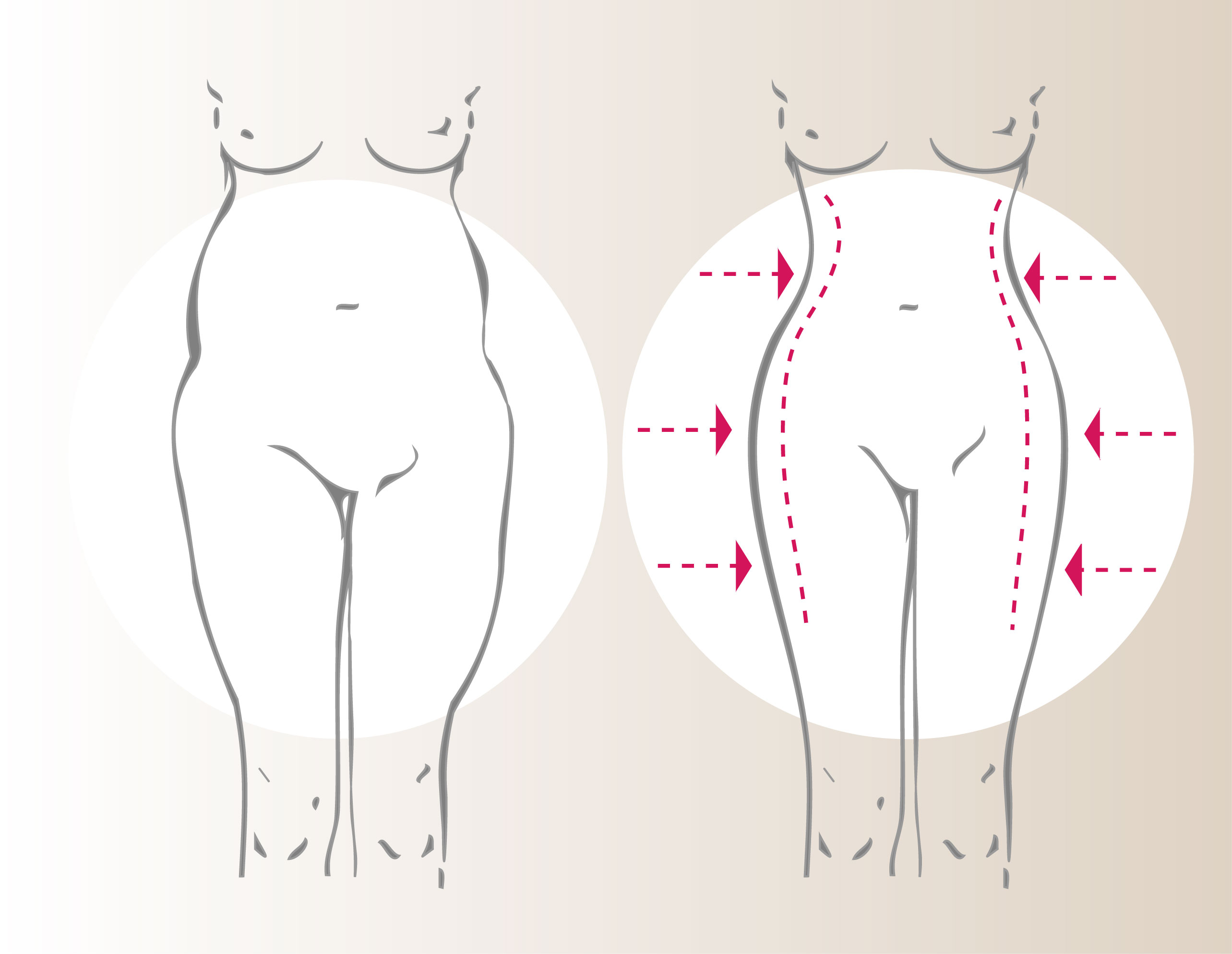 Lipoescultura