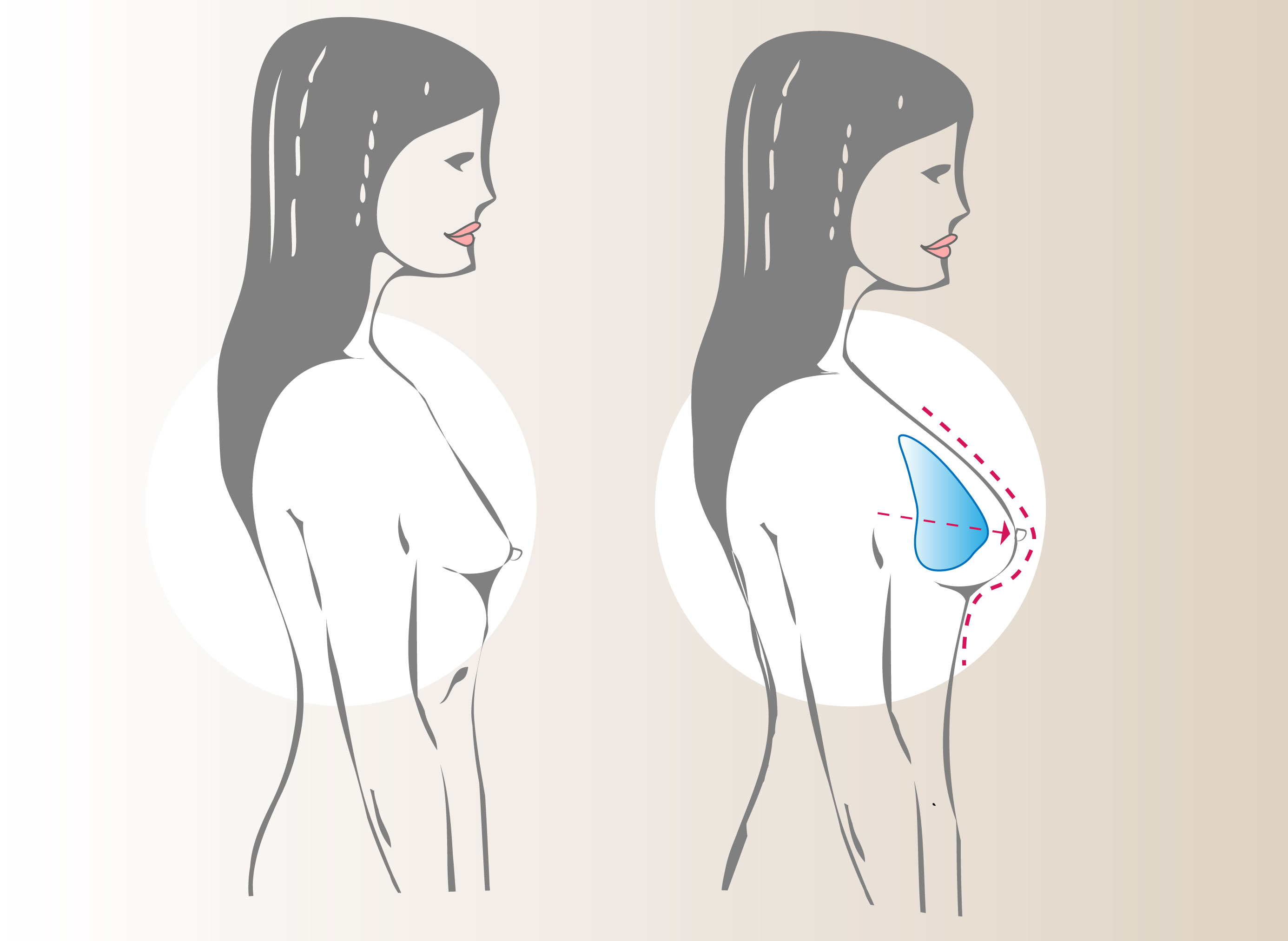 Mamoplastia de Aumento