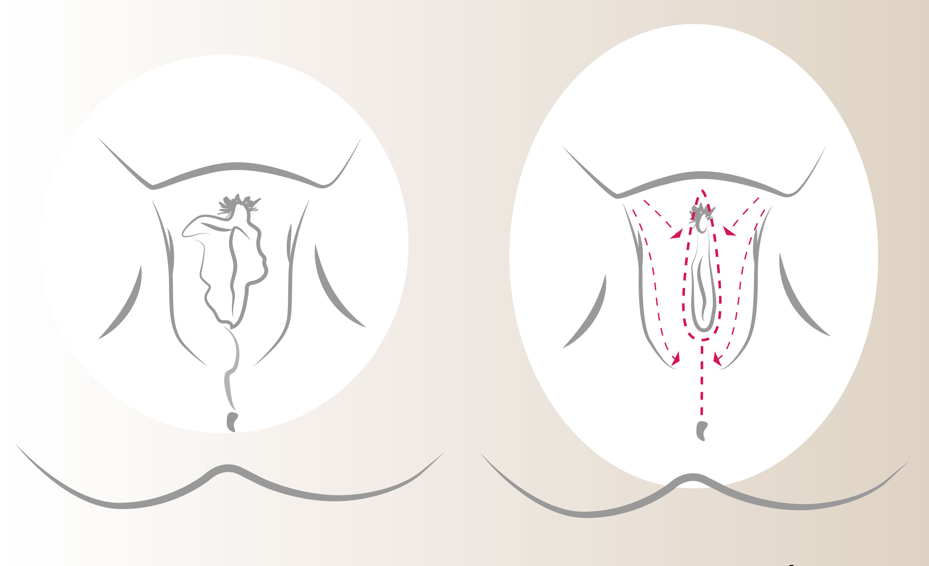 Vaginoplastia y Cirugas de Rejuvenecimiento Vaginal