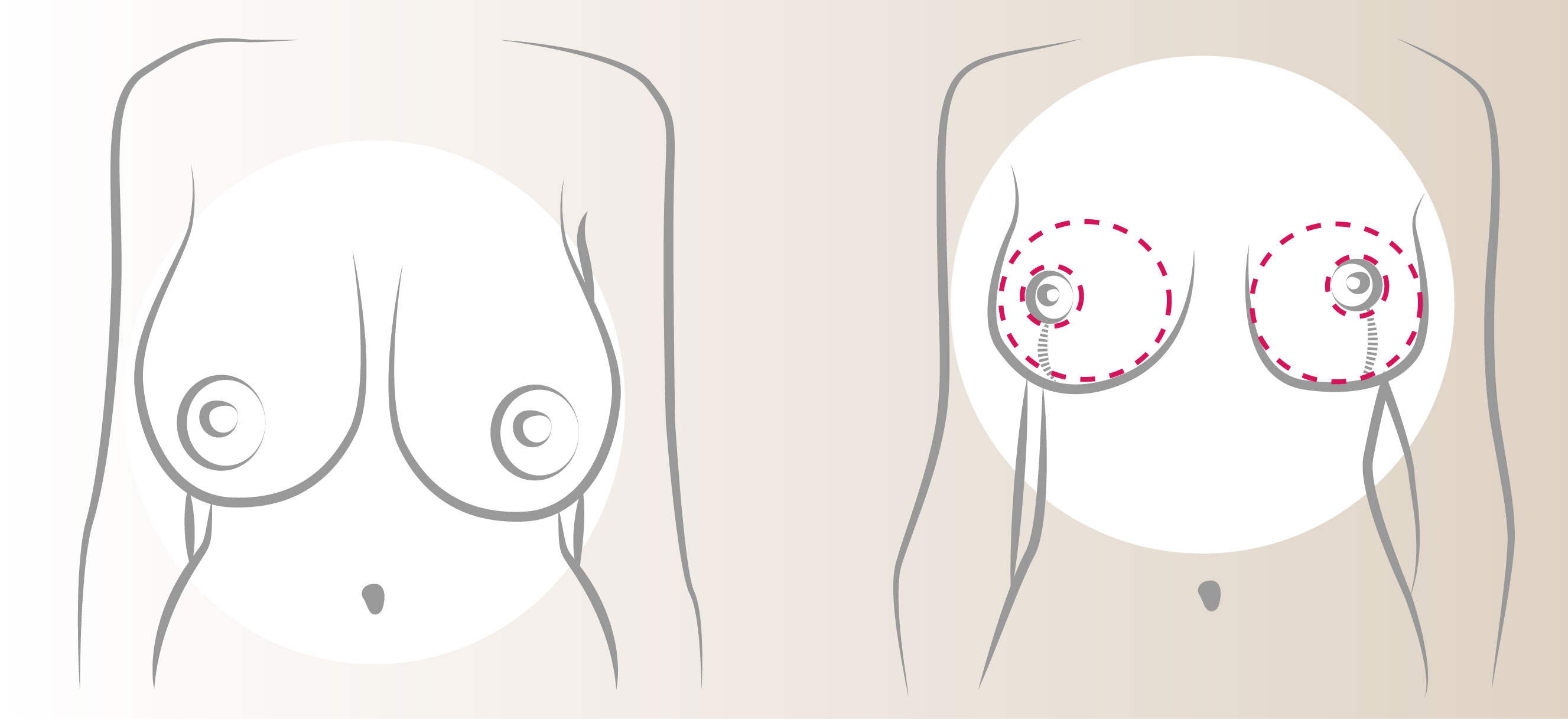 Mamoplastia de Reduccin